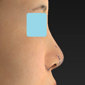 「耳介軟骨移植＋鼻尖縮小（close法）＋小鼻縮小+α」　新宿ラクル美容外科クリニック　２０代女性　デザイン　３月２９日