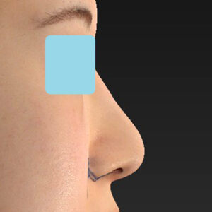 新宿ラクル美容外科クリニック　山本厚志　「貴族手術（鼻翼基部プロテーゼ）＋ 小鼻縮小+α法」　デザイン　３月３１日