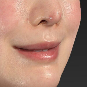 新宿ラクル美容外科クリニック　山本厚志　「貴族手術（鼻翼基部プロテーゼ）」　手術直後　３月５日