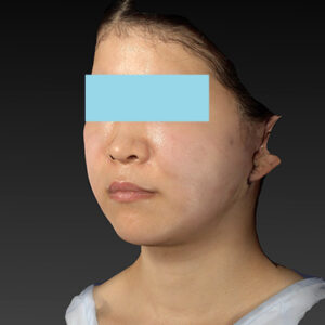 新宿ラクル美容外科クリニック　山本厚志　「ナチュラルフェイスリフト」「ライポライフ脂肪吸引（メーラーファット+ジョールファット）」　手術直後　３月２０日