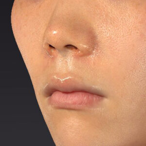 新宿ラクル美容外科クリニック　山本厚志　「猫手術（鼻唇角形成術）+ 貴族手術（鼻翼基部プロテーゼ）」　手術直後　３月１日