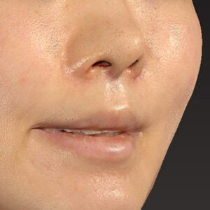 新宿ラクル美容外科クリニック　山本厚志　「猫手術（鼻唇角形成術）+ 貴族手術（鼻翼基部プロテーゼ）」　手術直後　３月２５日