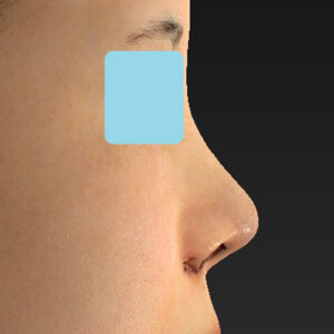 「耳介軟骨移植＋鼻尖縮小（close法）＋小鼻縮小+α」　新宿ラクル美容外科クリニック　２０代女性　手術直後　３月２９日