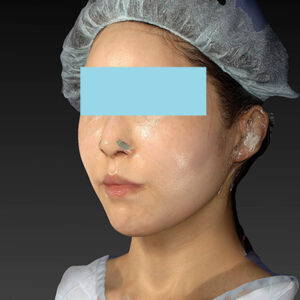 新宿ラクル美容外科クリニック　山本厚志　「アルテミスリフト」　手術直後　３月３０日