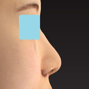 新宿ラクル美容外科クリニック　山本厚志　「貴族手術（鼻翼基部プロテーゼ）＋ 小鼻縮小+α法」　手術直後　３月３１日