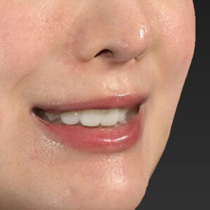 新宿ラクル美容外科クリニック　山本厚志　「貴族手術（鼻翼基部プロテーゼ）」　手術後１週間目　３月５日