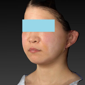 新宿ラクル美容外科クリニック　山本厚志　「ナチュラルフェイスリフト」「ライポライフ脂肪吸引（メーラーファット+ジョールファット）」　手術後１週間目　３月２０日