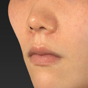 新宿ラクル美容外科クリニック　山本厚志　「猫手術（鼻唇角形成術）+ 貴族手術（鼻翼基部プロテーゼ）」　手術後１週間目　３月１日