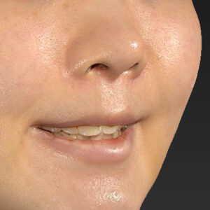 新宿ラクル美容外科クリニック　山本厚志　「猫手術（鼻唇角形成術）+ 貴族手術（鼻翼基部プロテーゼ）」　手術後１週間目　３月２５日