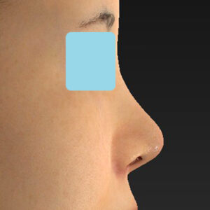 「耳介軟骨移植＋鼻尖縮小（close法）＋小鼻縮小+α」　新宿ラクル美容外科クリニック　２０代女性　手術後１週間目　３月２９日