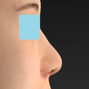 新宿ラクル美容外科クリニック　山本厚志　「貴族手術（鼻翼基部プロテーゼ）＋ 小鼻縮小+α法」　手術後１週間目　３月３１日