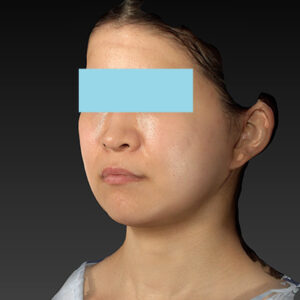 新宿ラクル美容外科クリニック　山本厚志　「ナチュラルフェイスリフト」「ライポライフ脂肪吸引（メーラーファット+ジョールファット）」　手術後１ヶ月目　３月２０日