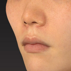 新宿ラクル美容外科クリニック　山本厚志　「猫手術（鼻唇角形成術）+ 貴族手術（鼻翼基部プロテーゼ）」　手術後１ヶ月目　３月１日