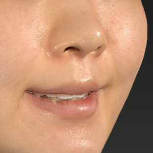 新宿ラクル美容外科クリニック　山本厚志　「猫手術（鼻唇角形成術）+ 貴族手術（鼻翼基部プロテーゼ）」　手術後１ヶ月目　３月２５日