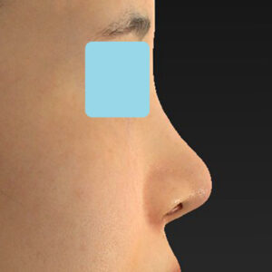 「耳介軟骨移植＋鼻尖縮小（close法）＋小鼻縮小+α」　新宿ラクル美容外科クリニック　２０代女性　手術後１ヶ月目　３月２９日