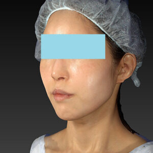 新宿ラクル美容外科クリニック　山本厚志　「アルテミスリフト」　手術後１ヶ月目　３月３０日