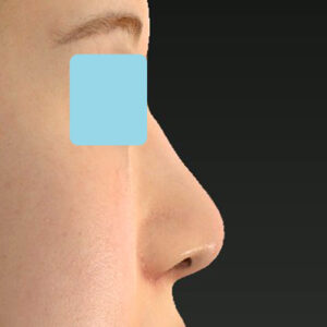 新宿ラクル美容外科クリニック　山本厚志　「貴族手術（鼻翼基部プロテーゼ）＋ 小鼻縮小+α法」　手術後１ヶ月目　３月３１日