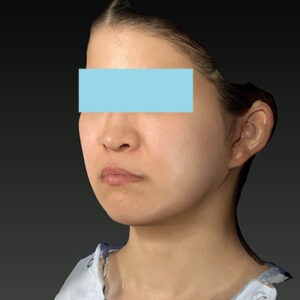 新宿ラクル美容外科クリニック　山本厚志　「ナチュラルフェイスリフト」「ライポライフ脂肪吸引（メーラーファット+ジョールファット）」　手術後２ヶ月目　３月２０日