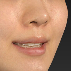 新宿ラクル美容外科クリニック　山本厚志　「猫手術（鼻唇角形成術）+ 貴族手術（鼻翼基部プロテーゼ）」　手術後２ヶ月目　３月２５日