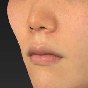 新宿ラクル美容外科クリニック　山本厚志　「猫手術（鼻唇角形成術）+ 貴族手術（鼻翼基部プロテーゼ）」　手術後２ヶ月目　３月１日