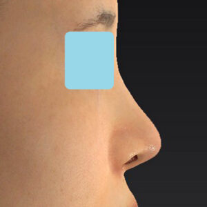 「耳介軟骨移植＋鼻尖縮小（close法）＋小鼻縮小+α」　新宿ラクル美容外科クリニック　２０代女性　手術後２ヶ月目　３月２９日