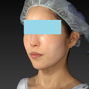 新宿ラクル美容外科クリニック　山本厚志　「アルテミスリフト」　手術後２ヶ月目　３月３０日