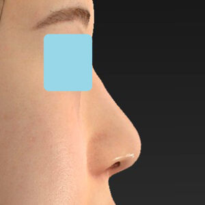 新宿ラクル美容外科クリニック　山本厚志　「貴族手術（鼻翼基部プロテーゼ）＋ 小鼻縮小+α法」　手術後2ヶ月目　３月３１日