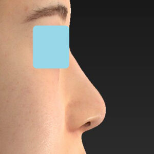 新宿ラクル美容外科クリニック　山本厚志　「貴族手術（鼻翼基部プロテーゼ）＋ 小鼻縮小+α法」　手術後３ヶ月目　４月１０日