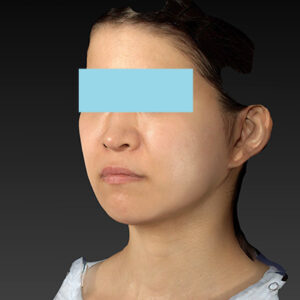 新宿ラクル美容外科クリニック　山本厚志　「ナチュラルフェイスリフト」「ライポライフ脂肪吸引（メーラーファット+ジョールファット）」　手術後３ヶ月目　３月２０日