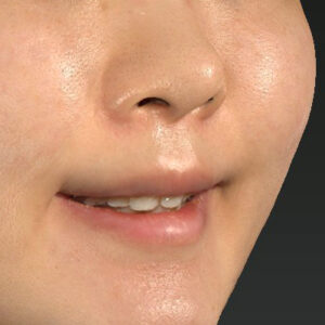 新宿ラクル美容外科クリニック　山本厚志　「猫手術（鼻唇角形成術）+ 貴族手術（鼻翼基部プロテーゼ）」　手術後３ヶ月目　４月１３日