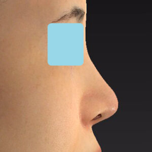 「耳介軟骨移植＋鼻尖縮小（close法）＋小鼻縮小+α」　新宿ラクル美容外科クリニック　２０代女性　手術後３ヶ月目　３月２９日