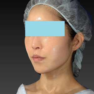 新宿ラクル美容外科クリニック　山本厚志　「アルテミスリフト」　手術後６ヶ月目　３月３０日