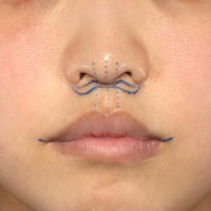 新宿ラクル美容外科クリニック　山本厚志　「人中短縮術（リップリフト）＋口角挙上（スマイルリップ）」　デザイン　４月１９日