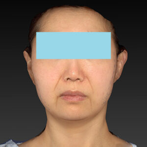 新宿ラクル美容外科クリニック　山本厚志　ナチュラルフェイスネックリフト　デザイン　４月２０日