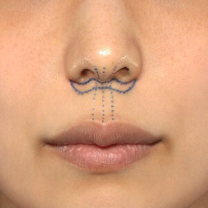 新宿ラクル美容外科クリニック　山本厚志　「人中短縮術（リップリフト）」　デザイン　４月２１日