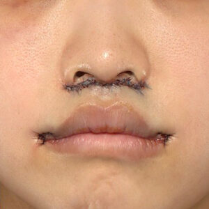 新宿ラクル美容外科クリニック　山本厚志　「人中短縮術（リップリフト）＋口角挙上（スマイルリップ）」　手術直後　４月１９日