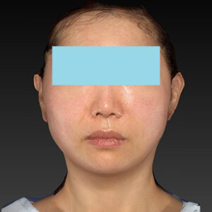 新宿ラクル美容外科クリニック　山本厚志　ナチュラルフェイスネックリフト　手術直後　４月２０日