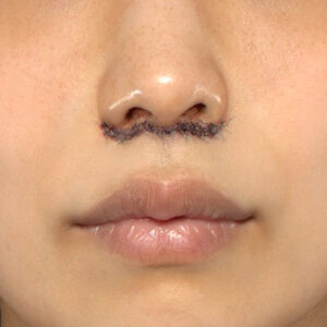 新宿ラクル美容外科クリニック　山本厚志　「人中短縮術（リップリフト）」　手術直後　４月２１日