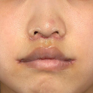 新宿ラクル美容外科クリニック　山本厚志　「人中短縮術（リップリフト）＋口角挙上（スマイルリップ）」　手術後１週間目　４月１９日