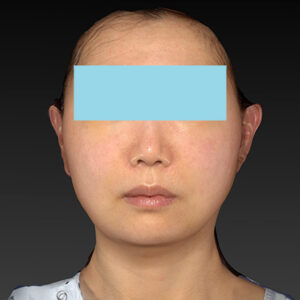 新宿ラクル美容外科クリニック　山本厚志　ナチュラルフェイスネックリフト　手術後１週間目　４月２０日