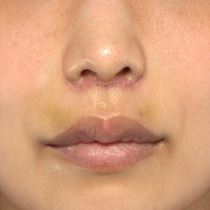 新宿ラクル美容外科クリニック　山本厚志　「人中短縮術（リップリフト）」　手術後１週間目　４月２１日