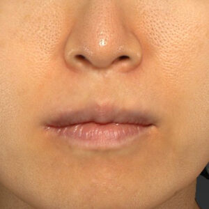 新宿ラクル美容外科クリニック　山本厚志　「外側人中短縮術（上口唇挙上術）修正 + 口角挙上（スマイルリフト）修正」　手術後１２ヶ月目　９月２９日