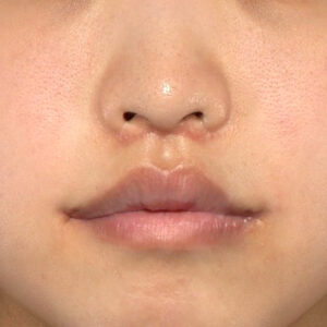 新宿ラクル美容外科クリニック　山本厚志　「人中短縮術（リップリフト）＋口角挙上（スマイルリップ）」　手術後１ヶ月目　４月１９日