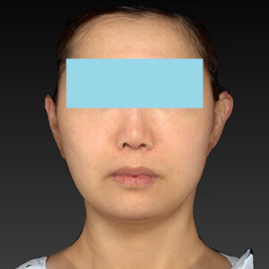 新宿ラクル美容外科クリニック　山本厚志　ナチュラルフェイスネックリフト　手術後１ヶ月目　４月２０日