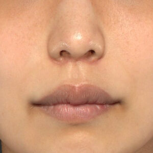 新宿ラクル美容外科クリニック　山本厚志　「人中短縮術（リップリフト）」　手術後１ヶ月目　４月２１日