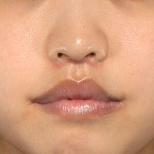新宿ラクル美容外科クリニック　山本厚志　「人中短縮術（リップリフト）＋口角挙上（スマイルリップ）」　手術後２ヶ月目　４月１９日