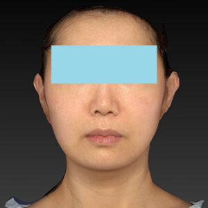 新宿ラクル美容外科クリニック　山本厚志　ナチュラルフェイスネックリフト　手術後２ヶ月目　４月２０日