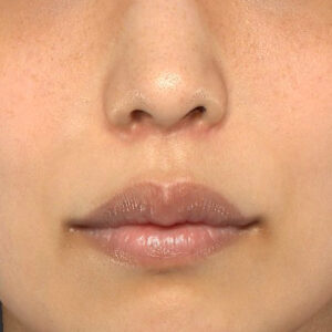 新宿ラクル美容外科クリニック　山本厚志　「人中短縮術（リップリフト）」　手術後２ヶ月目　４月２１日