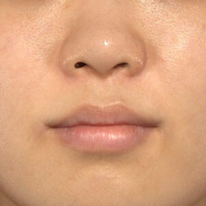 新宿ラクル美容外科クリニック　山本厚志　「猫手術（鼻唇角形成術）+ 貴族手術（鼻翼基部プロテーゼ）」　手術後６ヶ月目　６月８日