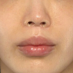新宿ラクル美容外科クリニック　山本厚志　「外側人中短縮術（上口唇挙上術）+ 人中短縮術（リップリフト）」　手術後６ヶ月目　７月４日